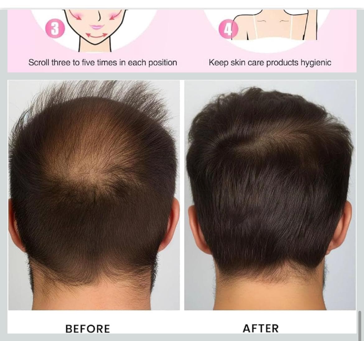 Derma Roller 0.5mm – Hair Growth, Beard Growth & Skin Rejuvenation thumbnail 4