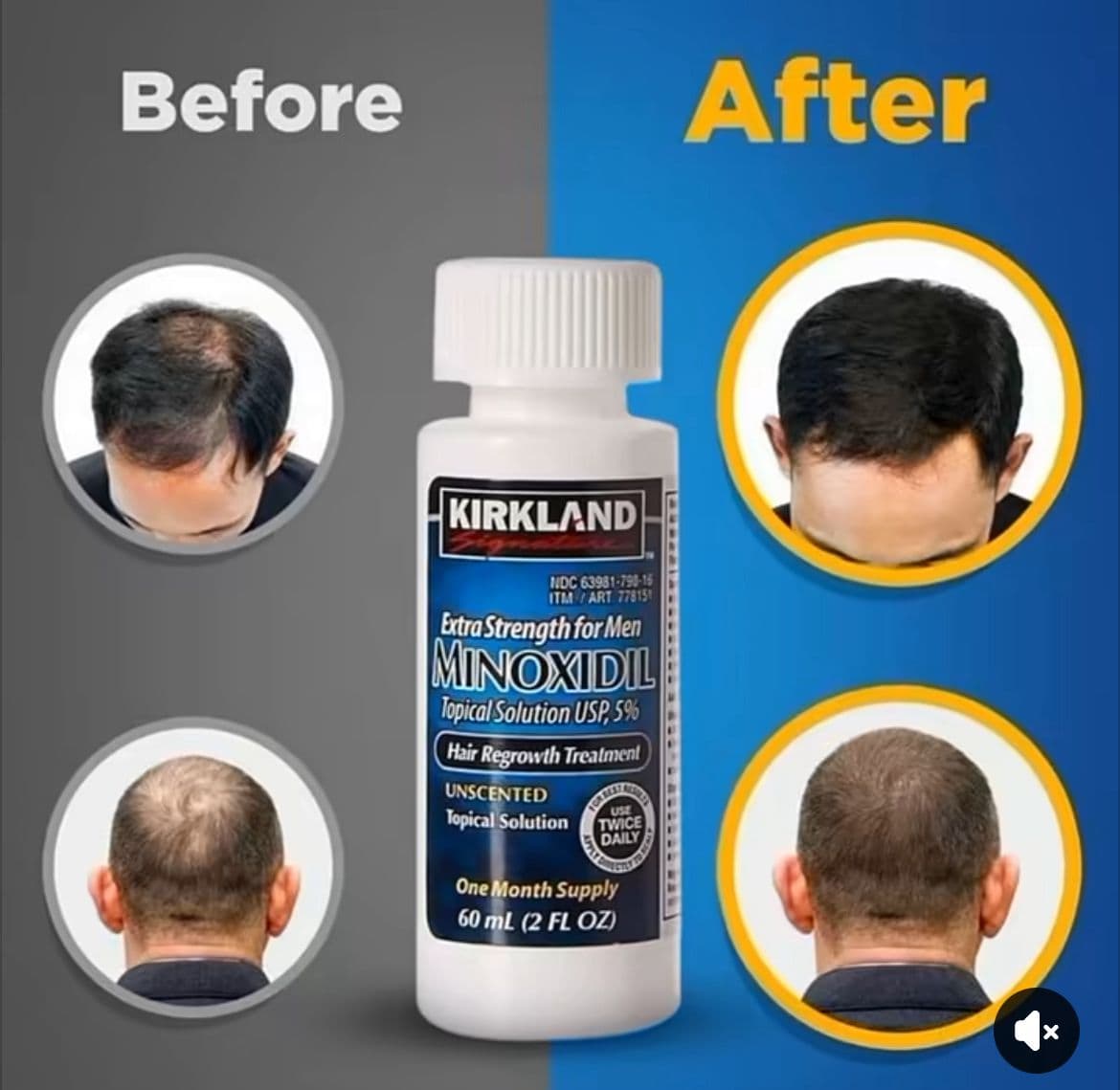 Kirkland Signature Minoxidil 5% – Hair Regrowth Solution thumbnail 1