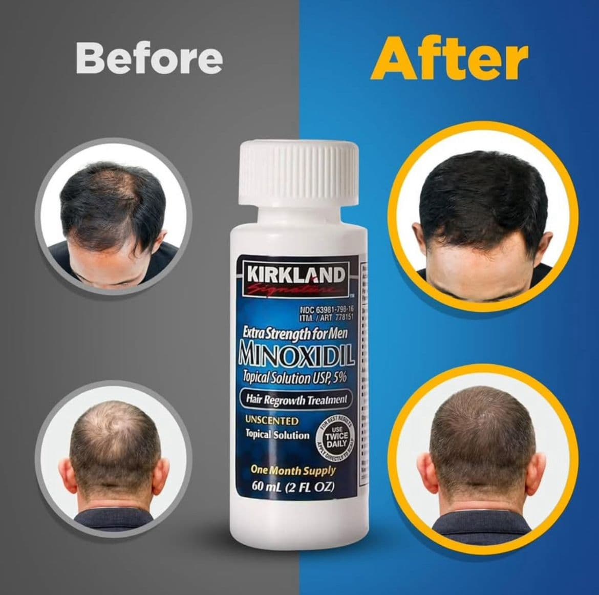 Kirkland Signature Minoxidil 5% – Hair Regrowth Solution thumbnail 5